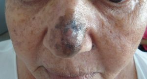 cancer-de-pele-melanoma-1