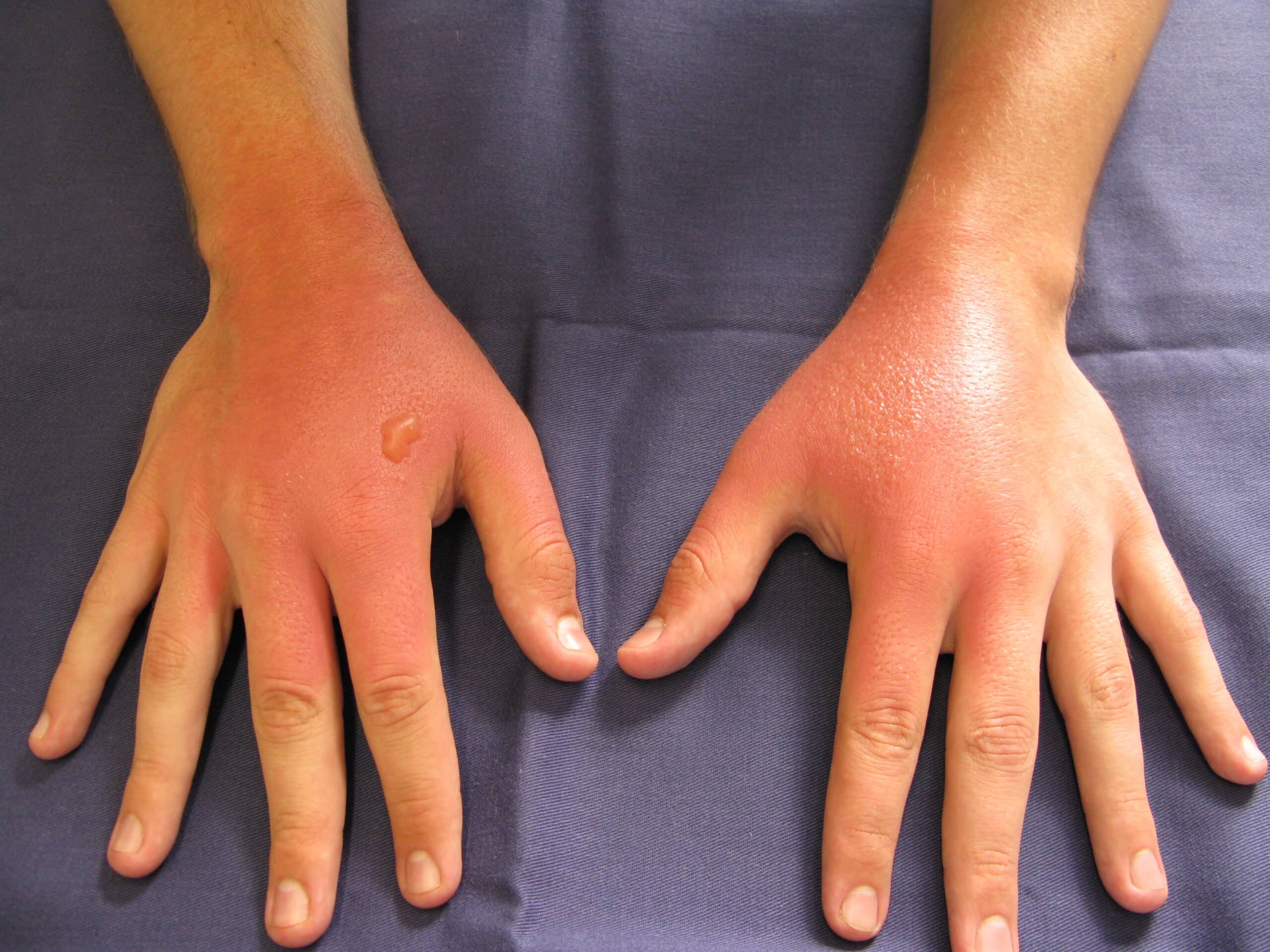 Dermatite de contato