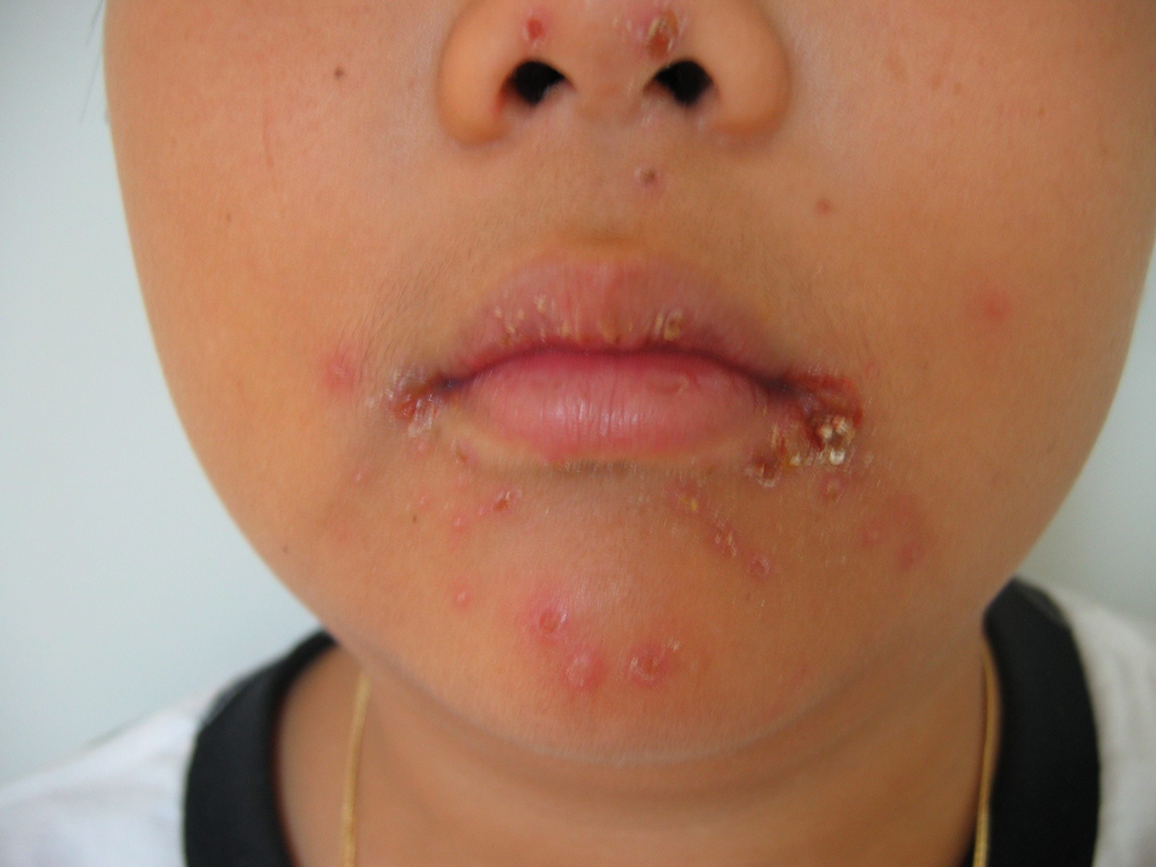 Herpes simples