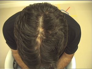 alopecia cicatricial 1