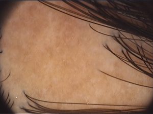 alopecia cicatricial