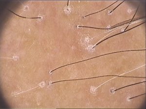 alopecia frontal fibrosante 1