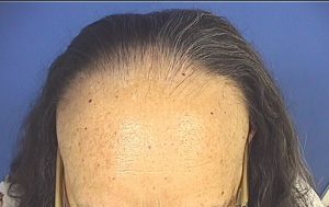 alopecia frontal fibrosante 2