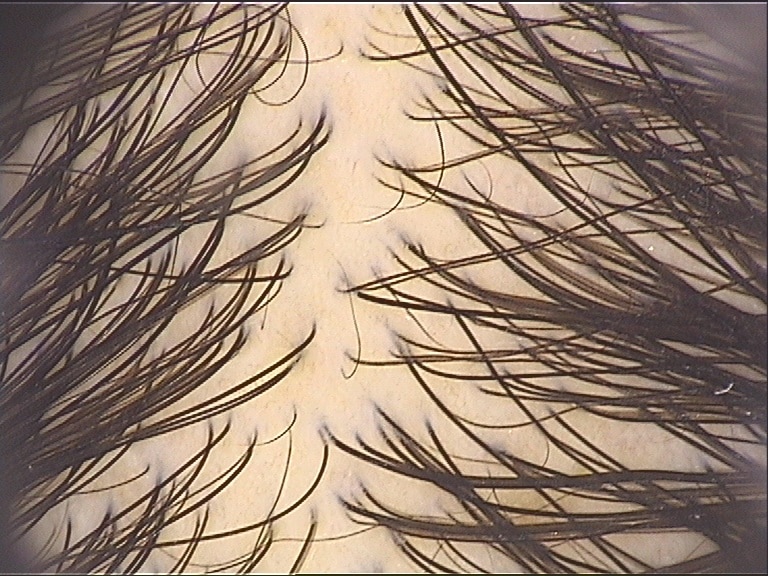 dermatoscopia de couro cabeludo