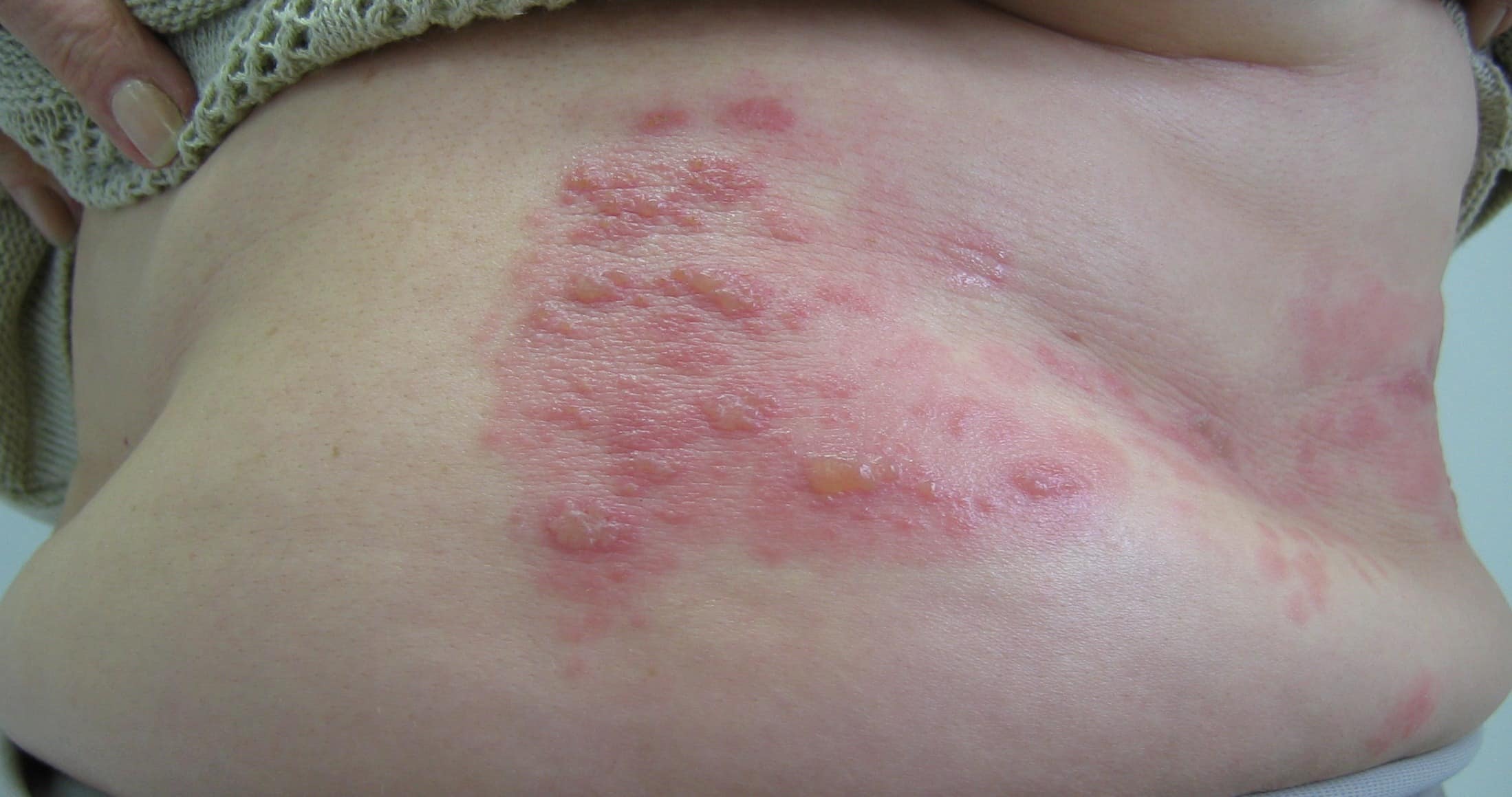 Herpes zoster