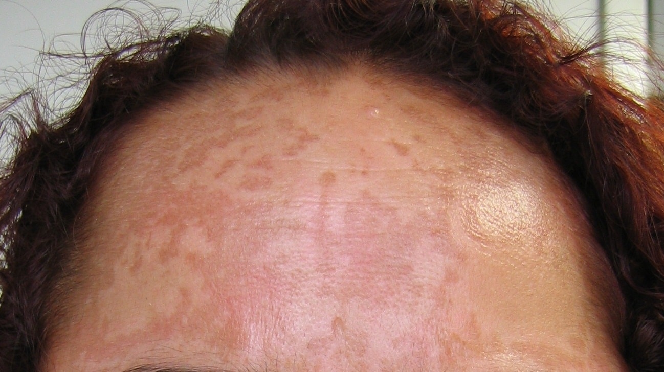 Melasma