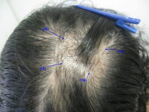Tricotilomania 2