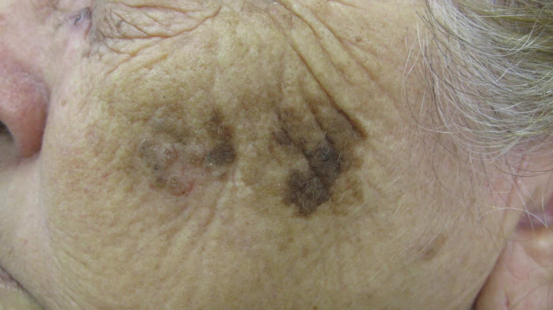 Queratose seborreica