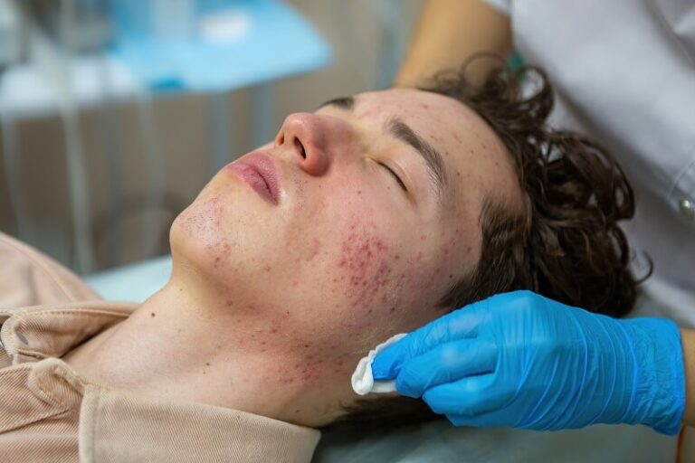 Acne- o que é, principais causas, sintomas e tratamentos