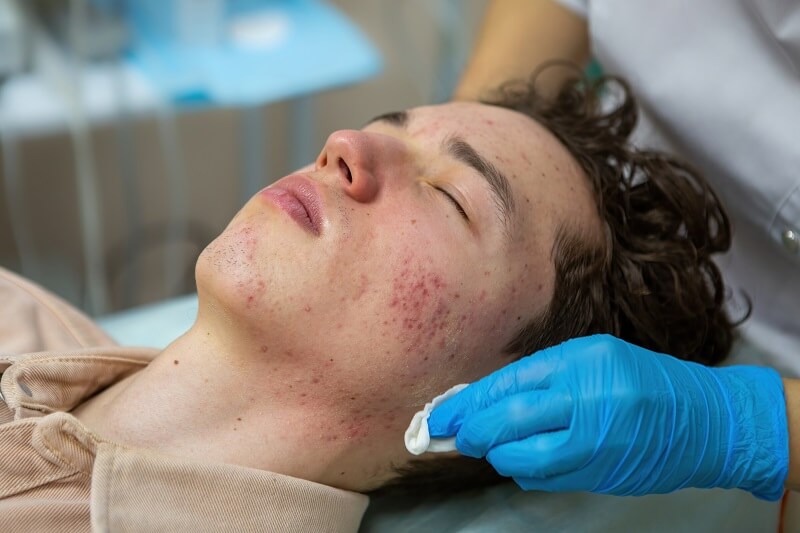 Acne- o que é, principais causas, sintomas e tratamentos