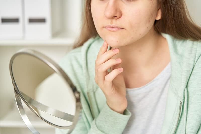 Como surge a acne