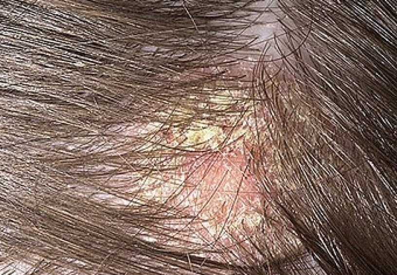 Dermatite Seborreica
