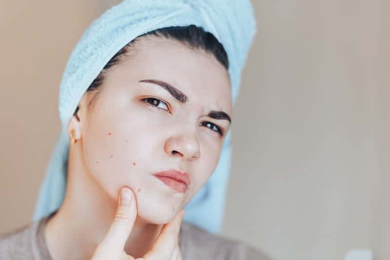 o que pode piorar acne
