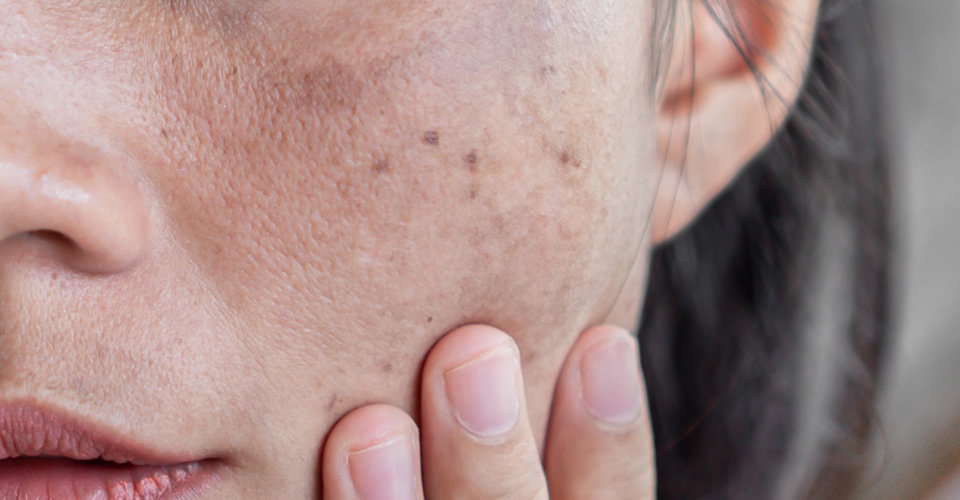 Melasma a mancha que assombra as mulheres
