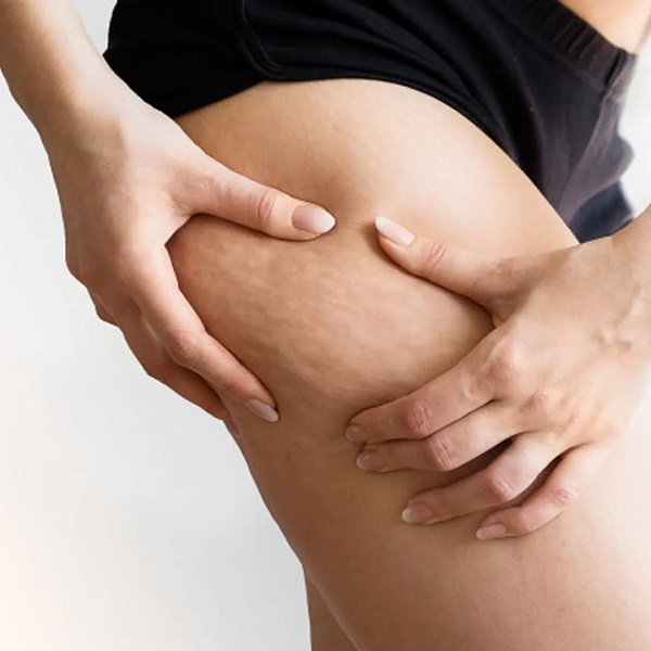 tratamento para celulite
