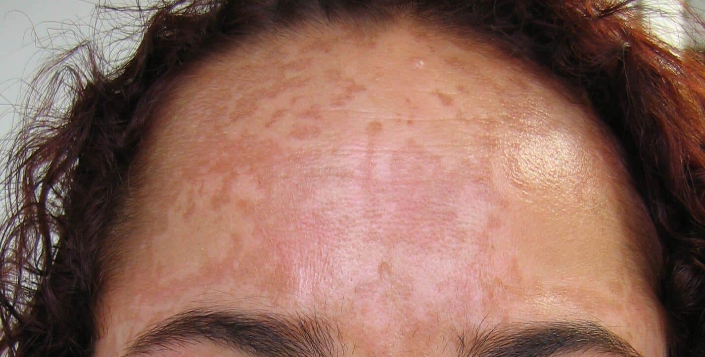 O uso de protetor solar é essencial para quem tem melasma