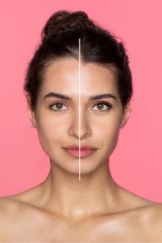 Harmonização Facial