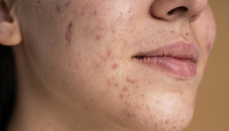 tratamento acne