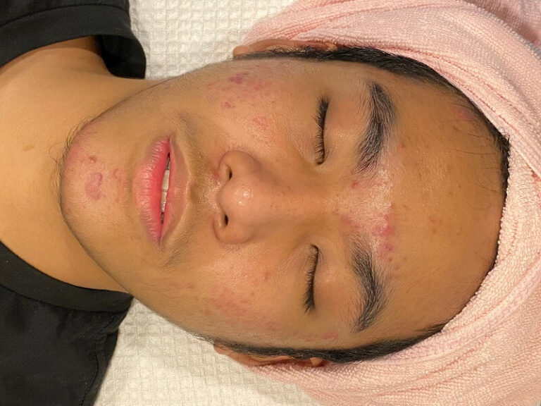 alimentação na acne adulta