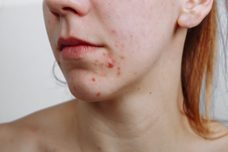 Se você sofre dessa condição, agende uma consulta com o dermatologista