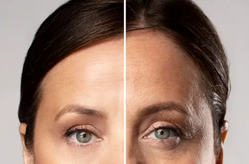 TRATAMENTO DA REGIÃO AO REDOR DOS OLHOS